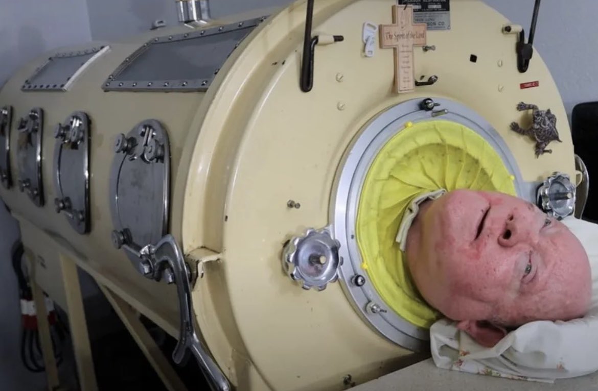 An Extraordinary Life: Polio Survivor Paul Alexander Passes Away After 70 Years in Iron Lung 1 Polio Survivor Paul Alexander